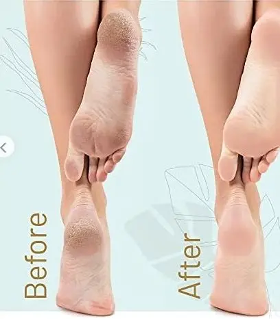 [CX112] Heel Peel Kit